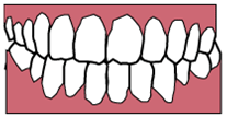 前歯の開咬の矯正