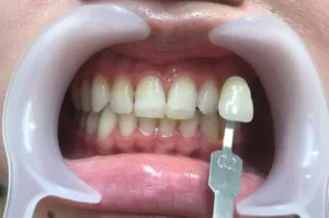 ホワイトニングの症例